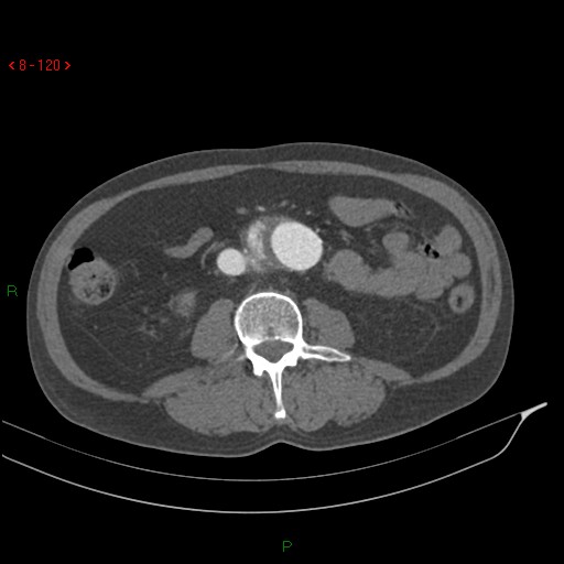 Abdominal aortic aneurysm rupture with aortocaval fistula (Radiopaedia 14897-14841 Axial C+ arterial phase 120).jpg