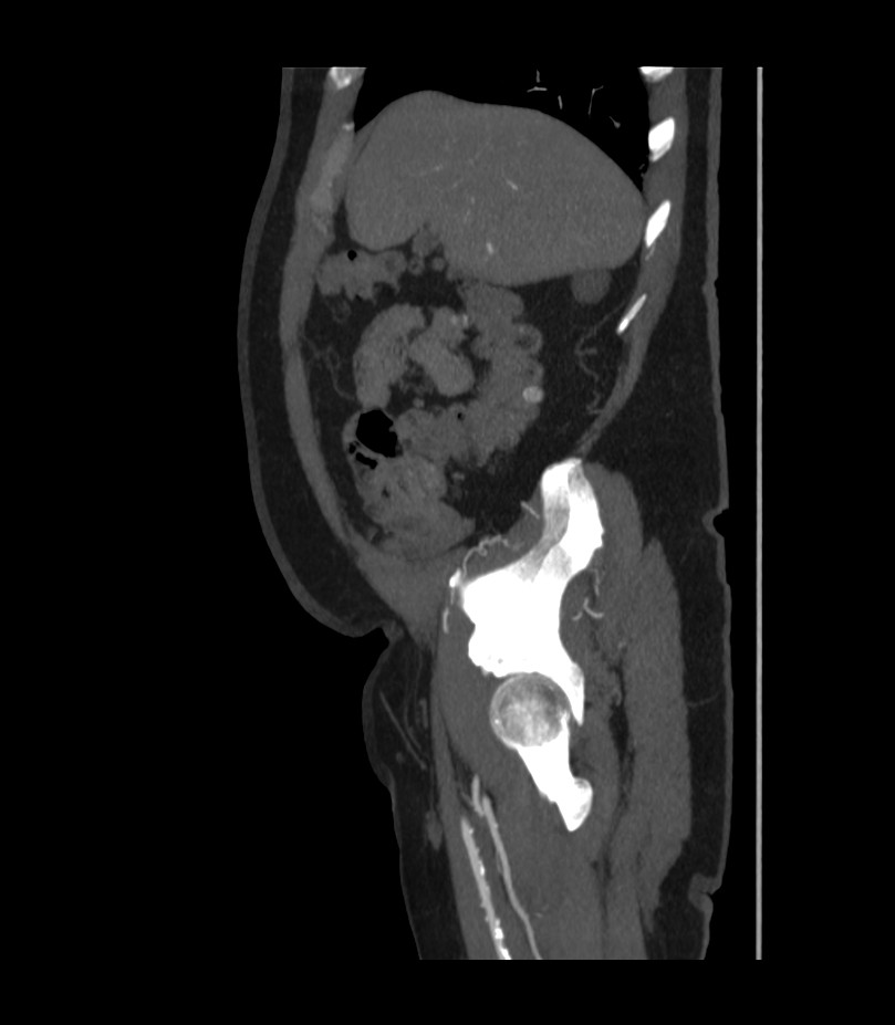 Abdominal aortic aneurysm with thrombus fissuration (Radiopaedia 46218-50618 Sagittal C+ arterial phase 11).jpg