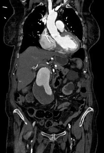 Abdominal aortic aneurysm with thrombus fissuration (Radiopaedia 73192-83919 Coronal C+ arterial phase 26).jpg