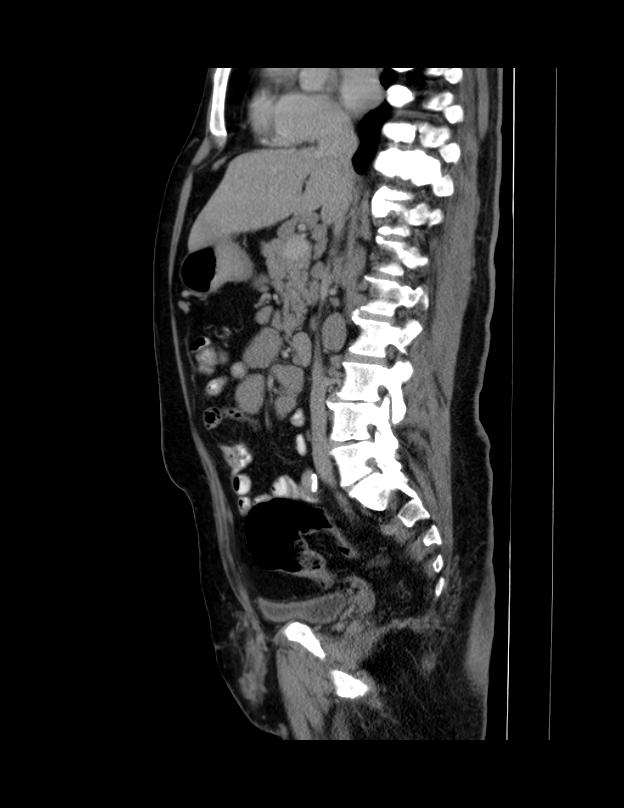 Abdominal lymphoma - with sandwich sign (Radiopaedia 53486-59492 Sagittal C+ portal venous phase 44).jpg