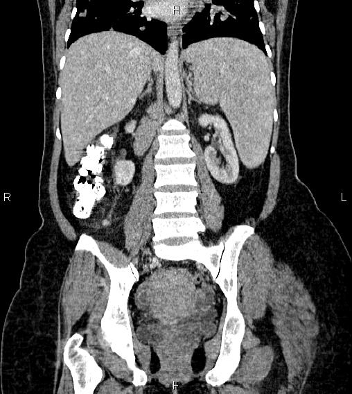 Abdominal lymphoma with sandwich sign (Radiopaedia 84378-99704 Coronal C+ portal venous phase 41).jpg