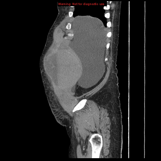 Abdominal wall hematoma (Radiopaedia 9427-10112 Sagittal C+ portal venous phase 94).jpg