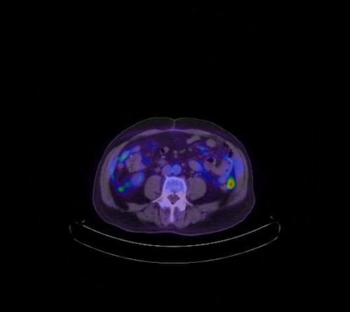 Abdominal wall metastasis from colorectal carcinoma (Radiopaedia 31016-31719 Axial 56).jpg