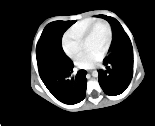 File:Abdominopelvic rhabdomyosarcoma (Radiopaedia 78356-90984 Axial C+ portal venous phase 27).jpg