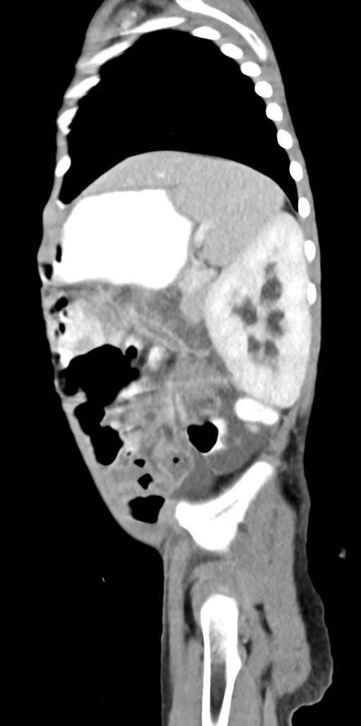 Abdominopelvic rhabdomyosarcoma (Radiopaedia 78356-90984 Sagittal C+ portal venous phase 23).jpg
