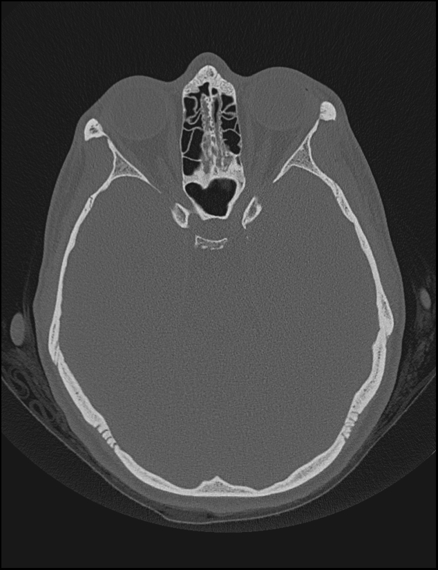 Aberrant right internal carotid artery (Radiopaedia 65191-74198 Axial non-contrast 71).jpg