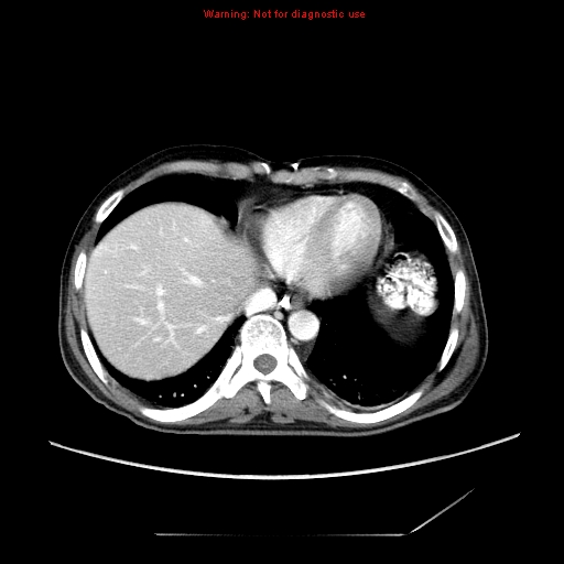 Aberrant right subclavian artery (Radiopaedia 9379-10071 Axial C+ arterial phase 52).jpg