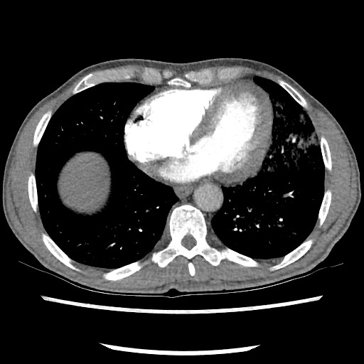 Accessory left horizontal fissure with lingular pneumonia (Radiopaedia 53763-59843 Axial C+ CTPA 66).jpg