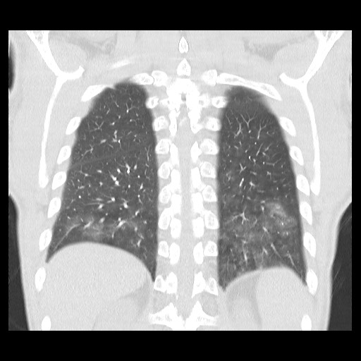 File:Accessory left horizontal fissure with lingular pneumonia (Radiopaedia 53763-59843 Coronal lung window 36).jpg