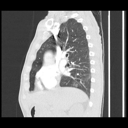 Accessory left horizontal fissure with lingular pneumonia (Radiopaedia 53763-59843 Sagittal lung window 28).jpg