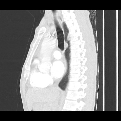 File:Accessory left horizontal fissure with lingular pneumonia (Radiopaedia 53763-59843 Sagittal lung window 34).jpg