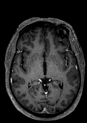 Accessory middle cerebral artery (Radiopaedia 73114-83828 Axial T1 C+ 46).jpg