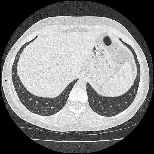 File:Accidental foreign body aspiration (seamstress needle) (Radiopaedia 77740-89983 Axial lung window 59).jpg