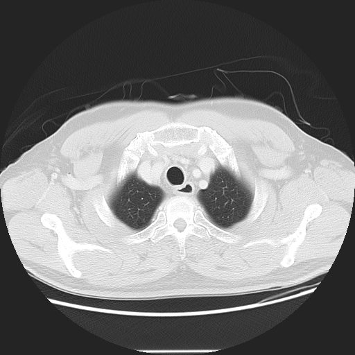 Achalasia (Radiopaedia 8831-9629 Axial lung window 13).jpg