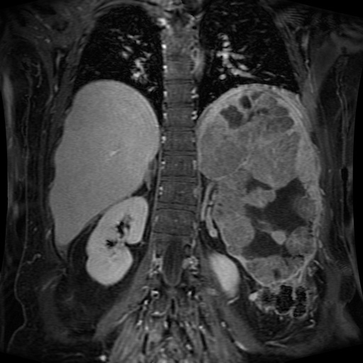 Acinar cell carcinoma of the pancreas (Radiopaedia 75442-86668 Coronal T1 C+ fat sat 63).jpg