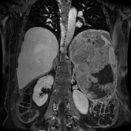 File:Acinar cell carcinoma of the pancreas (Radiopaedia 75442-86668 Coronal T1 C+ fat sat 73).jpg