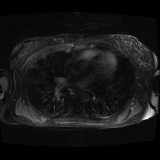 Acinar cell carcinoma of the pancreas (Radiopaedia 75442-86668 D 155).jpg