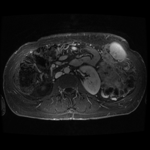 Acinar cell carcinoma of the pancreas (Radiopaedia 75442-86668 D 18).jpg