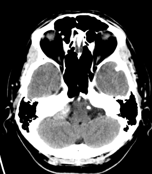 File:Acoustic schwannoma (Radiopaedia 33045-34065 Axial C+ delayed 5).png