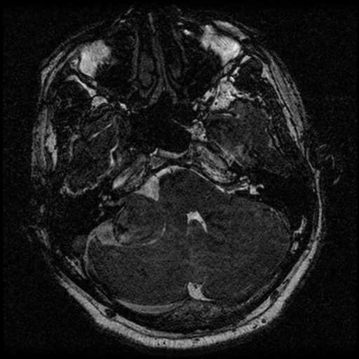 File:Acoustic schwannoma (Radiopaedia 39170-41387 Axial FIESTA 64).png