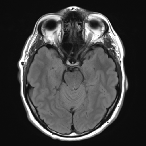 File:Acoustic schwannoma (Radiopaedia 50846-56358 Axial FLAIR 12).png