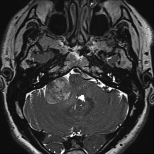 File:Acoustic schwannoma (Radiopaedia 50846-56358 Axial T2 17).png