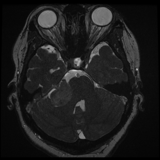 Acoustic schwannoma (Radiopaedia 57574-64536 Axial T2 52).png