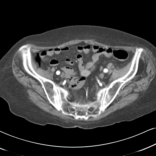 File:Active bleeding from duodenal ulcer with embolization (Radiopaedia 34216-35481 Axial C+ arterial phase 50).png