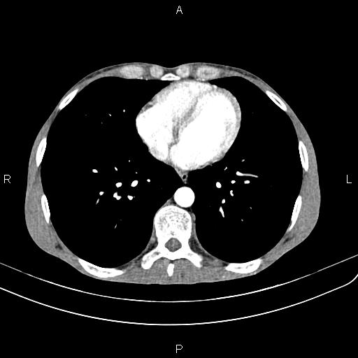 Active crohn disease (Radiopaedia 87133-103397 Axial C+ arterial phase 2).jpg