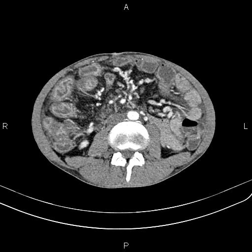Active crohn disease (Radiopaedia 87133-103397 Axial C+ arterial phase 56).jpg