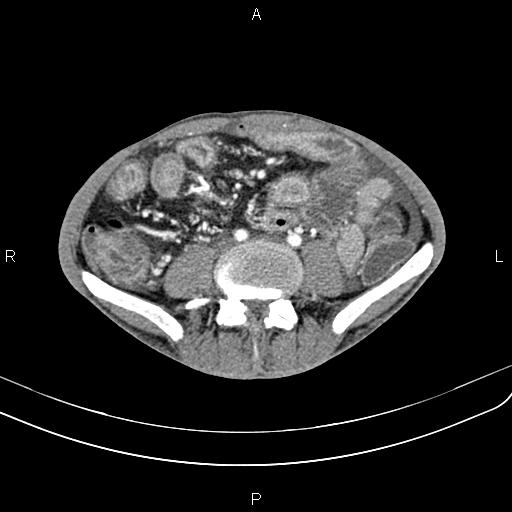 Active crohn disease (Radiopaedia 87133-103397 Axial C+ arterial phase 65).jpg