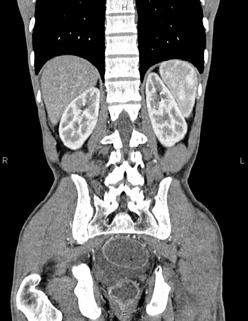 Active crohn disease (Radiopaedia 87133-103397 Coronal C+ arterial phase 50).jpg