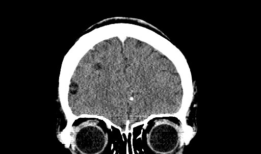 File:Active neurocysticercosis before and after therapy (Radiopaedia 71710-82099 Coronal C+ delayed 19).jpg