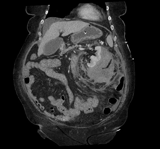 Active renal extravasation with large subcapsular and retroperitoneal hemorrhage (Radiopaedia 60975-68796 Coronal C+ portal venous phase 54).jpg