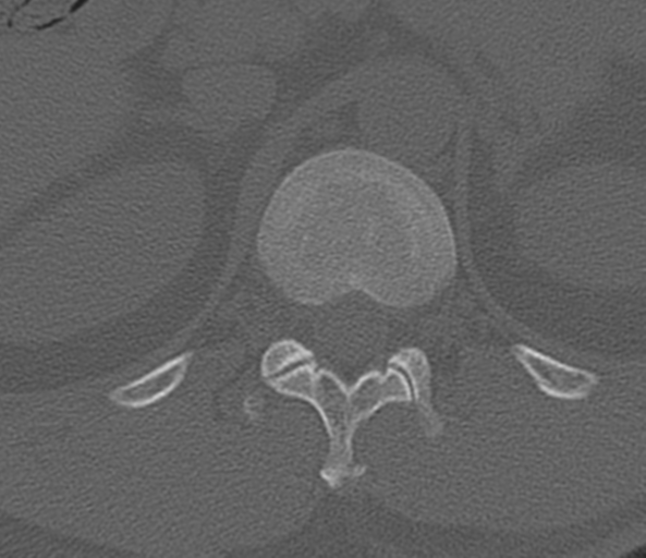 File:Acute L1 burst compression fracture (Radiopaedia 34430-35755 Axial bone window 5).png