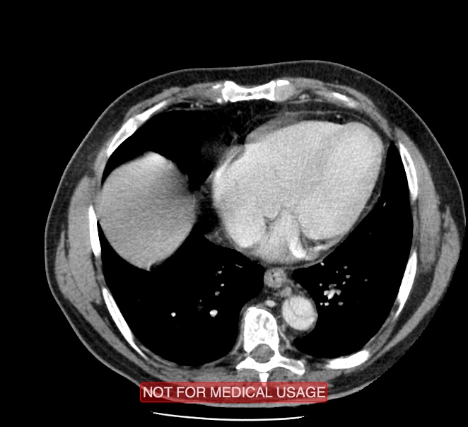 Acute aortic dissection - Stanford type A (Radiopaedia 40661-43285 Axial C+ portal venous phase 42).jpg