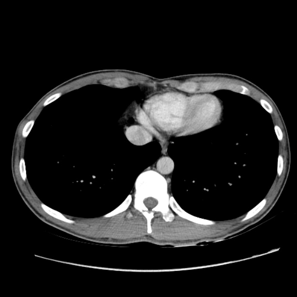 Acute appendicitis (Radiopaedia 27049-27227 Axial C+ portal venous phase 3).jpg
