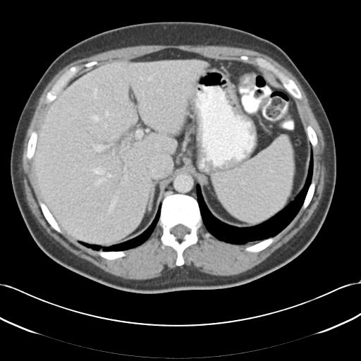 File:Acute appendicitis (Radiopaedia 30297-30934 Axial C+ portal venous phase 17).jpg