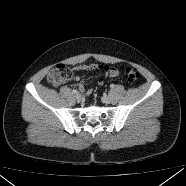 Acute appendicitis (Radiopaedia 38255-40270 Axial C+ portal venous phase 83).jpg