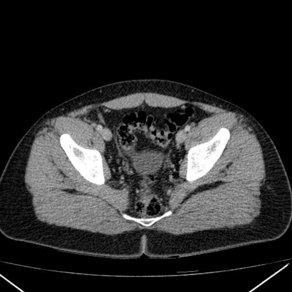 File:Acute appendicitis (Radiopaedia 38255-40270 Axial C+ portal venous phase 97).jpg