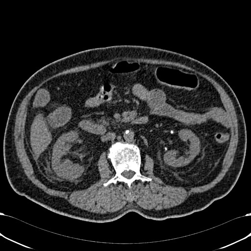Acute appendicitis (Radiopaedia 58627-65818 Axial non-contrast 39).jpg
