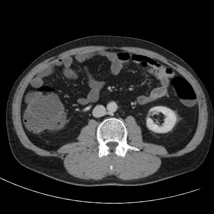 Acute appendicitis (Radiopaedia 66513-75790 Axial C+ portal venous phase 39).jpg