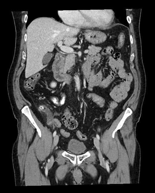 Acute appendicitis - large appendicoliths (Radiopaedia 61805-69820 Coronal C+ portal venous phase 59).jpg