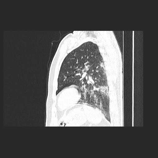 Acute appendicitis and COVID 19 pneumonia (Radiopaedia 76604-88380 Sagittal lung window 70).jpg