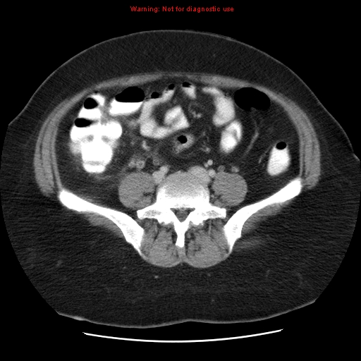 Acute appendicitis complicated by ovarian vein thrombophlebitis (Radiopaedia 16172-15851 Axial C+ portal venous phase 62).jpg