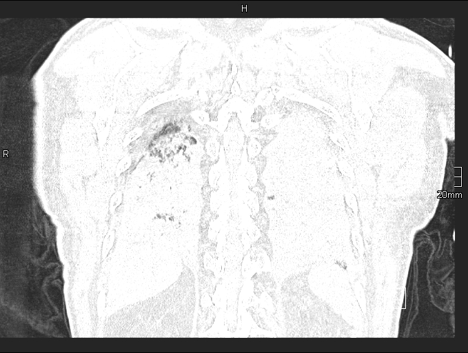 File:Acute aspiration pneumonitis (Radiopaedia 55642-62166 Coronal lung window 89).jpg