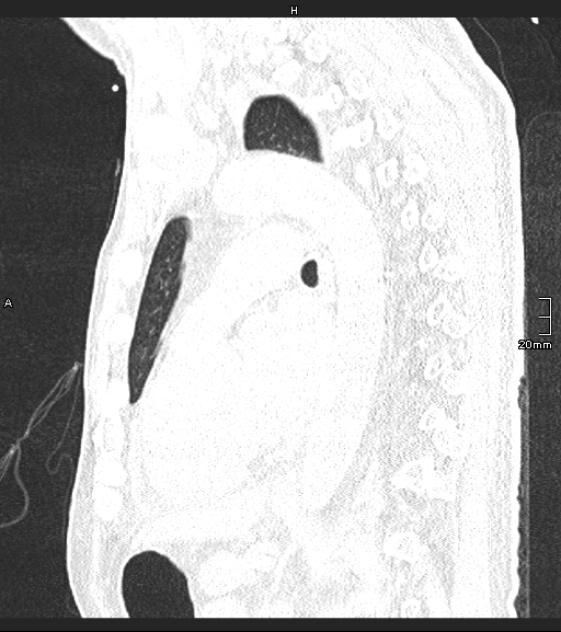 File:Acute aspiration pneumonitis (Radiopaedia 55642-62166 Sagittal lung window 62).jpg
