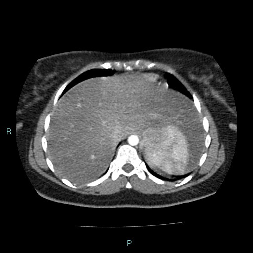 Acute bilateral pyelonephritis (Radiopaedia 37146-38881 Axial C+ arterial phase 18).jpg