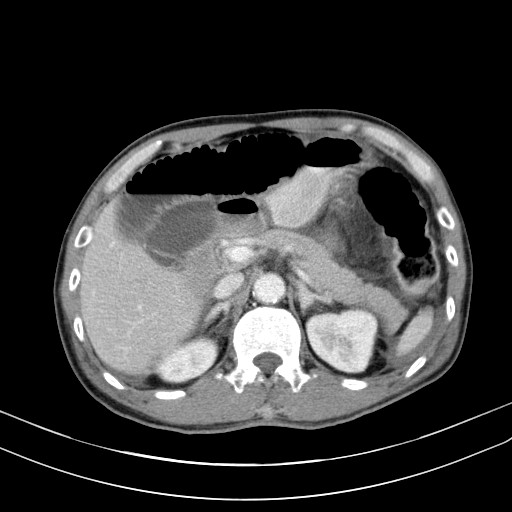 Acute bowel ischemia (Radiopaedia 87695-104114 Axial C+ portal venous phase 27).jpg