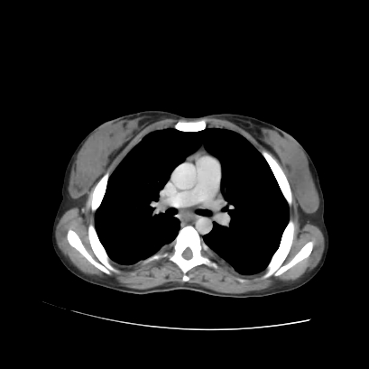 File:Acute calculous cholecystitis in patient with osteopetrosis (Radiopaedia 77871-90159 Axial C+ portal venous phase 1).jpg